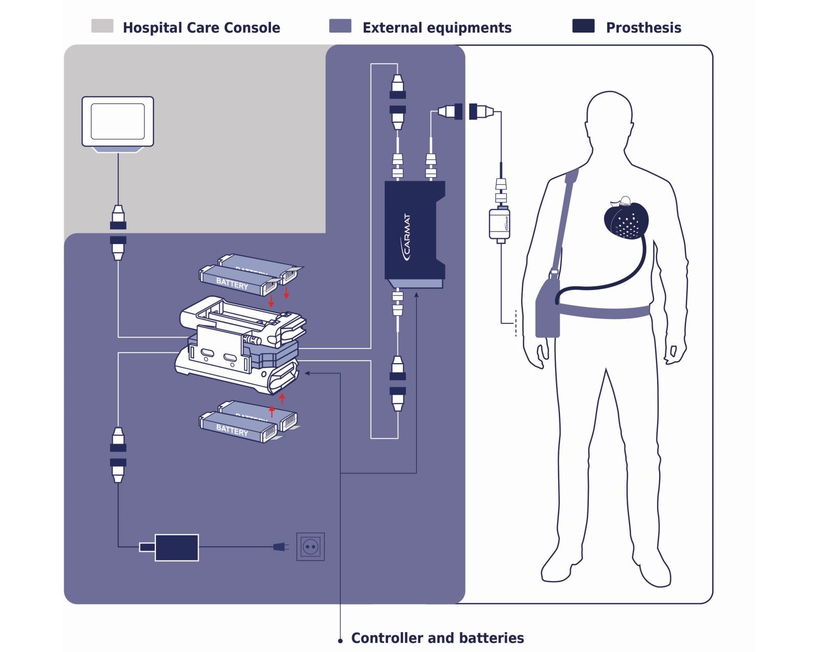 В Европе человеку впервые успешно пересадили искусственное сердце нового поколения